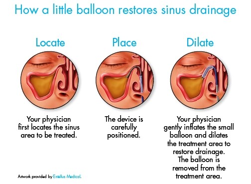 Treating Sinusitis in Children