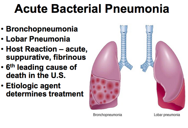 Pneumonia, bacterial
