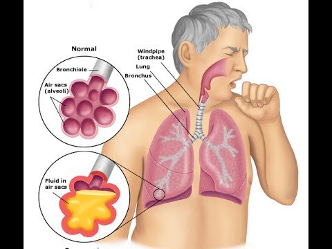 Pneumonia, bacterial