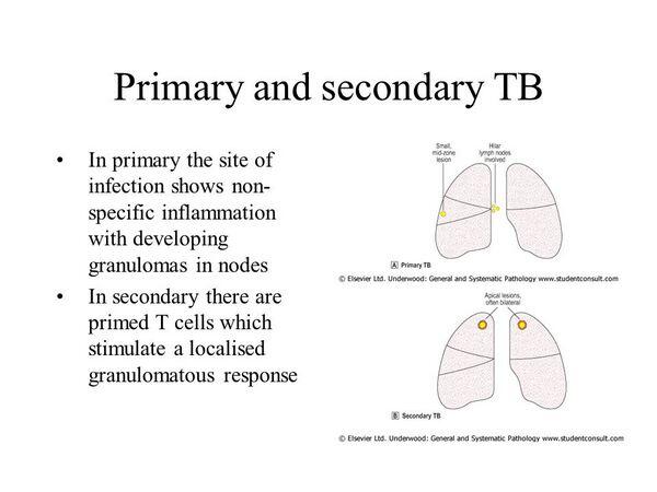 Primary Tuberculosis