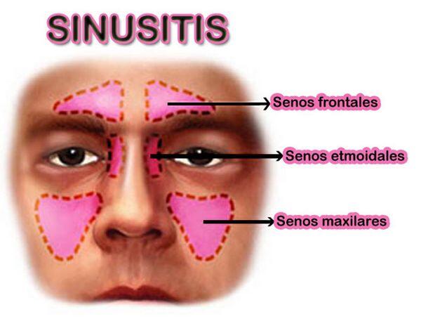 Sinusitis Sinusitis