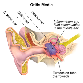 Otitis media Otitis media