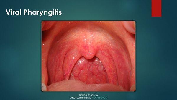Pharyngitis Pharyngitis
