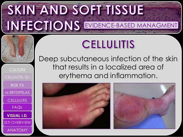 Skin and Soft Tissue Infections