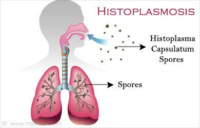 Histoplasmosis