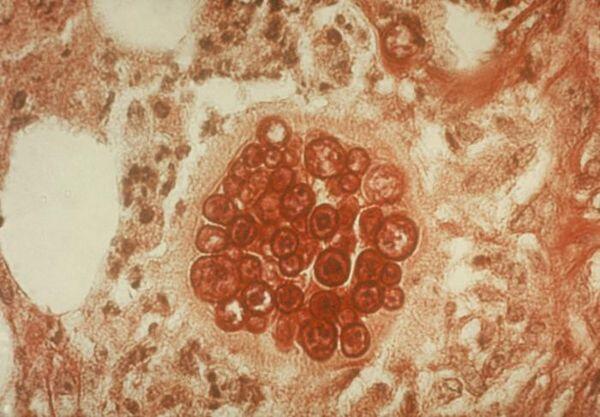 Coccidioidomycosis