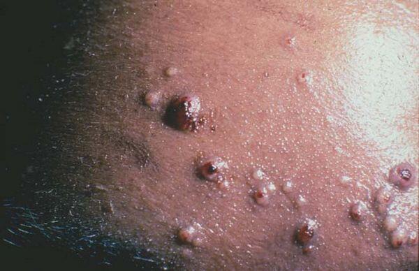 Cryptococcosis