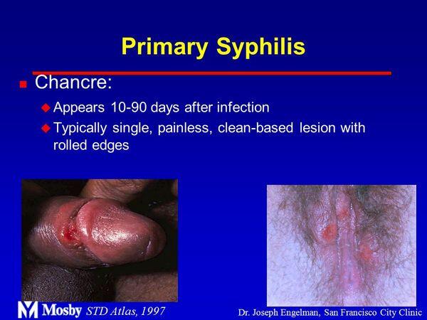 Primary Syphilis