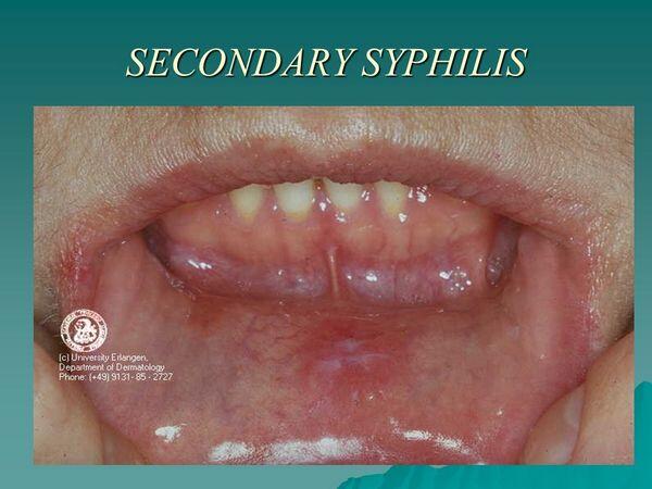 Secondary Syphilis