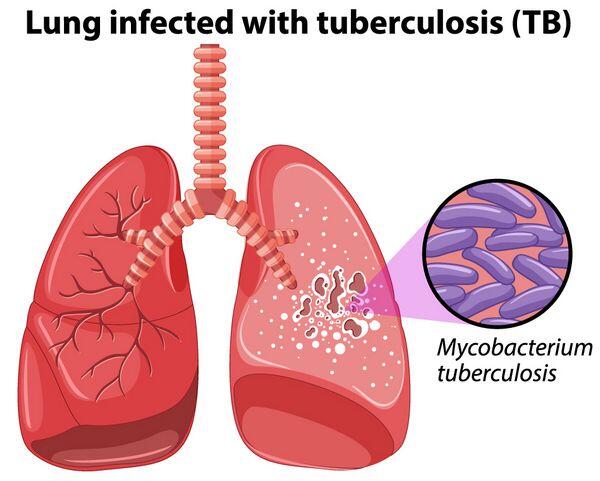 Tuberculosis