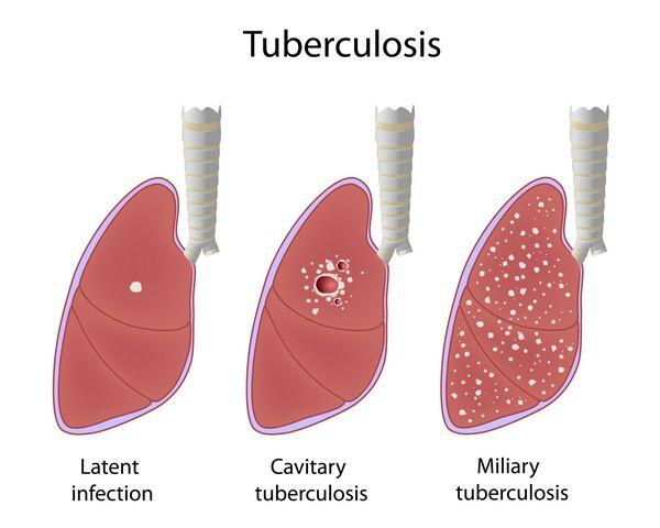 Tuberculosis