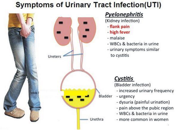 Urinary tract infection