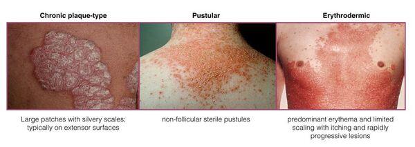 Streptococcal Infections