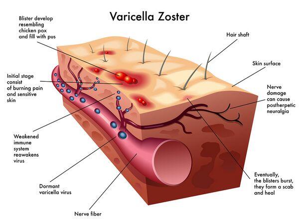 Varicella-Zoster Virus