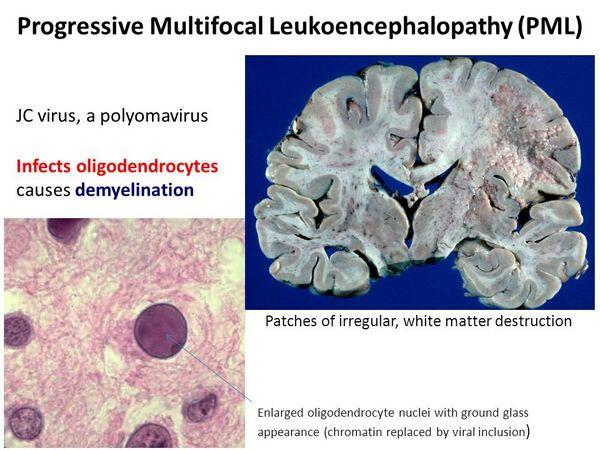 PROGRESSIVE MULTIFOCAL LEUKOENCEPHALOPATHY