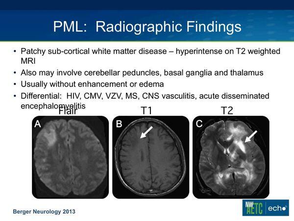 PROGRESSIVE MULTIFOCAL LEUKOENCEPHALOPATHY