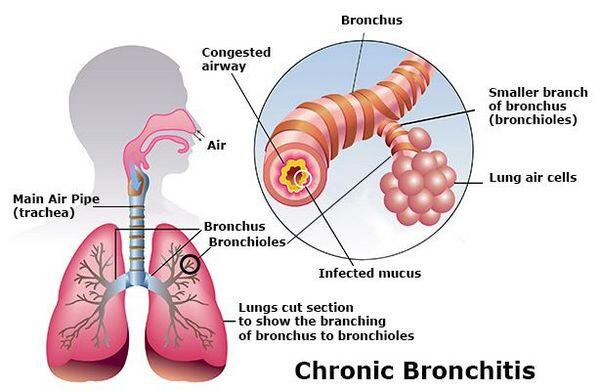 Who Gets Chronic Bronchitis? Who Gets Chronic Bronchitis?
